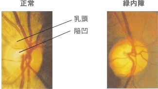 視神経乳頭の拡大写真