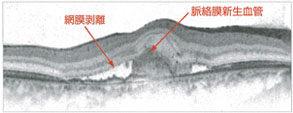 加齢黄斑変性