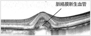 脈絡膜新生血管